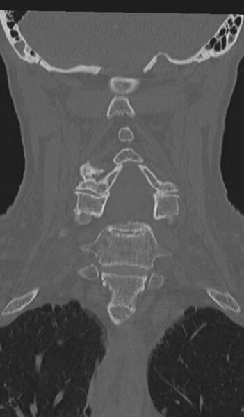 File:Acute on chronic subdural hematoma and thoracic vertebral injury in a multitrauma patient (Radiopaedia 31698-32619 Coronal bone window 34).jpg