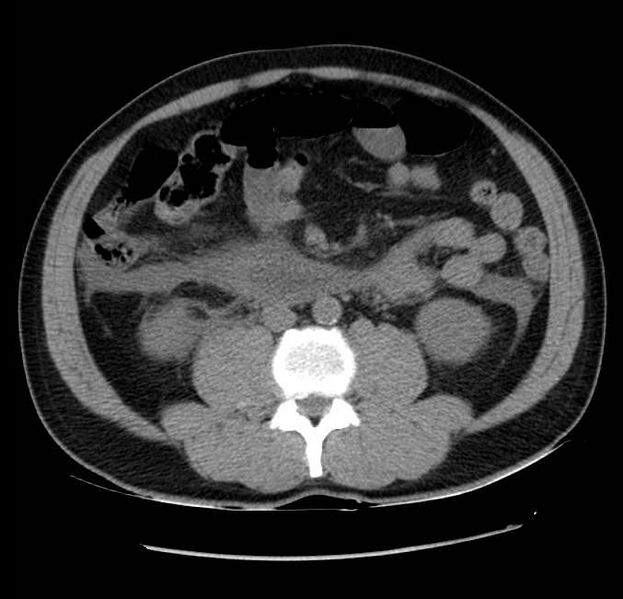 File:Acute pancreatitis - Balthazar E (Radiopaedia 23080-23110 Axial non-contrast 38).jpg