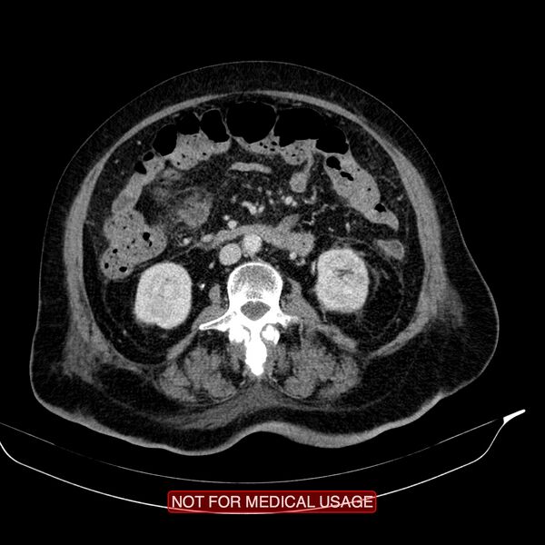 File:Acute pancreatitis with infected necrosis (Radiopaedia 26454-26585 Axial C+ portal venous phase 13).jpg