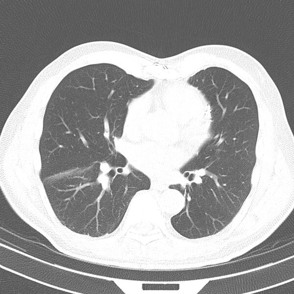 File:Acute pulmonary embolism (Radiopaedia 81677-95570 Axial lung window 26).jpg