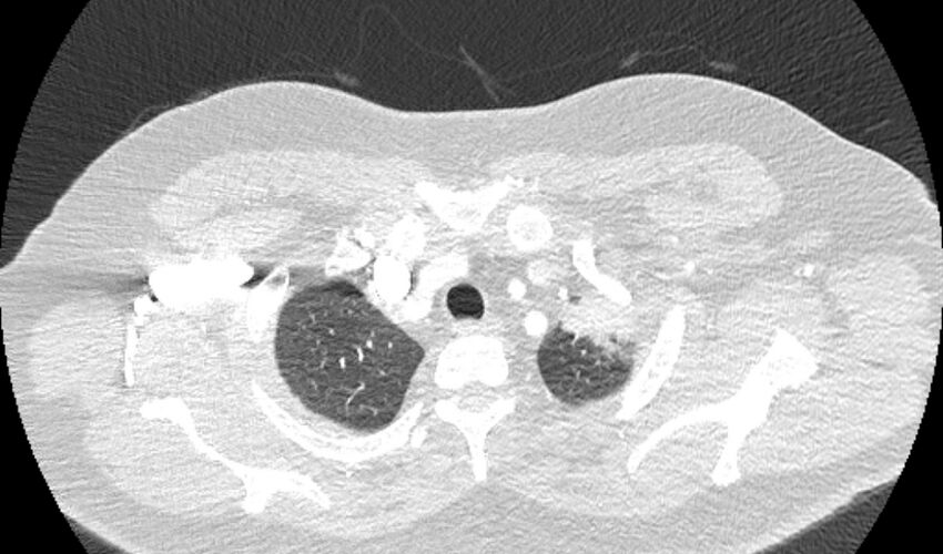 Acute pulmonary embolism with pulmonary infarcts (Radiopaedia 77688-89908 Axial lung window 4).jpg