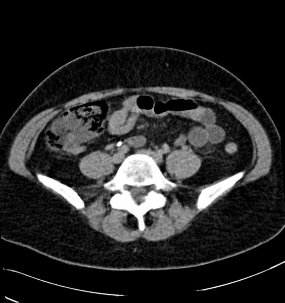 File:Acute pyelonephritis (Radiopaedia 40264-42816 Axial renal excretory phase 23).jpg