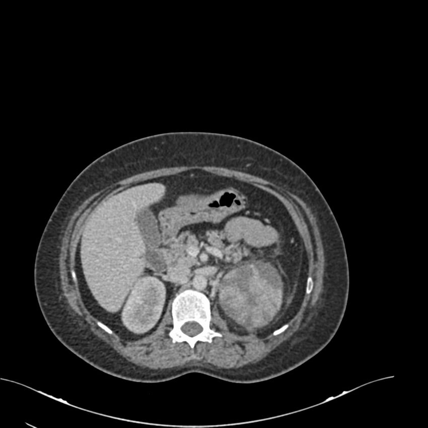 Acute pyelonephritis with renal vein thrombosis (Radiopaedia 58020-65053 Axial renal parenchymal phase 38).jpg