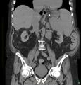 Acute renal failure post IV contrast injection- CT findings (Radiopaedia 47815-52557 Coronal non-contrast 25).jpg