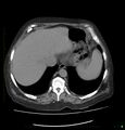 Acute renal failure post IV contrast injection- CT findings (Radiopaedia 47815-52559 Axial C+ portal venous phase 12).jpg