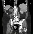 Acute renal failure post IV contrast injection- CT findings (Radiopaedia 47815-52559 Coronal C+ portal venous phase 26).jpg