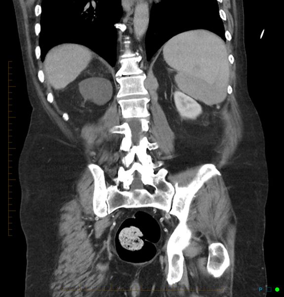 File:Acute renal failure post IV contrast injection- CT findings (Radiopaedia 47815-52559 Coronal C+ portal venous phase 26).jpg