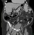 Acute renal failure post IV contrast injection- CT findings (Radiopaedia 47815-52559 Coronal C+ portal venous phase 8).jpg