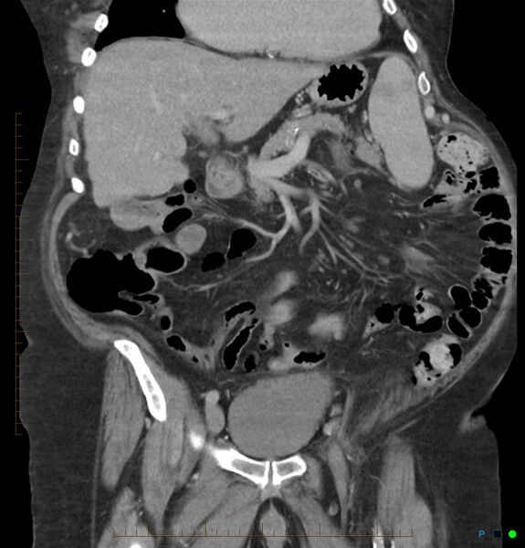 File:Acute renal failure post IV contrast injection- CT findings (Radiopaedia 47815-52559 Coronal C+ portal venous phase 8).jpg