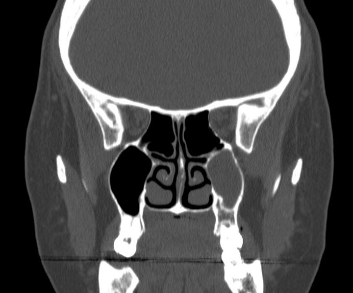File:Acute sinusitis (Radiopaedia 22419-22455 Coronal bone window 23).jpg