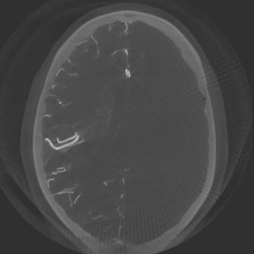 Acute subarachnoid hemorrhage and accessory anterior cerebral artery (Radiopaedia 69231-79010 Axial arterial - MIP 50).jpg
