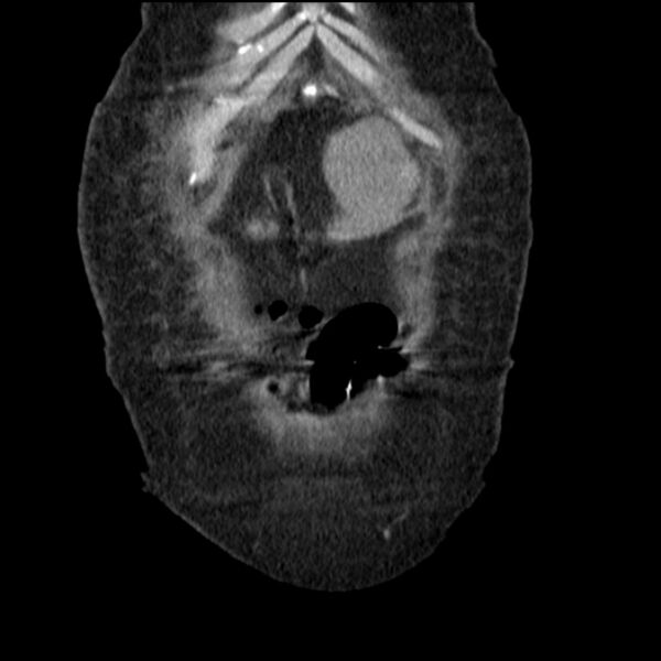 File:Acute tubular necrosis (Radiopaedia 28077-28334 G 14).jpg