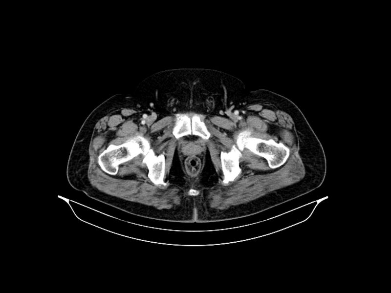 File:Adenocarcinoma of pancreas with hepatic metastasis (Radiopaedia 64332-73122 Axial C+ portal venous phase 101).jpg