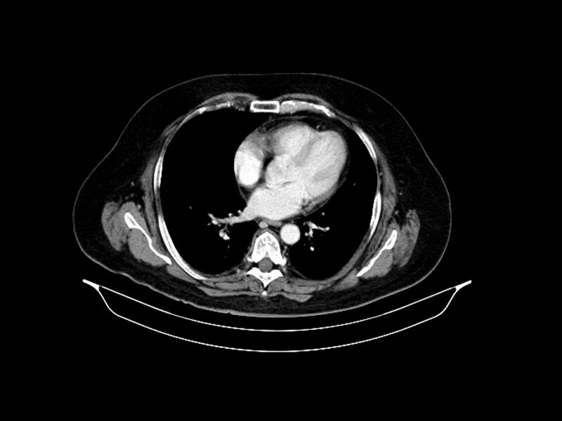 File:Adenocarcinoma of pancreas with hepatic metastasis (Radiopaedia 64332-73122 Axial C+ portal venous phase 8).jpg