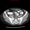 Adenocarcinoma of the colon (Radiopaedia 8191-9039 Axial liver window 56).jpg