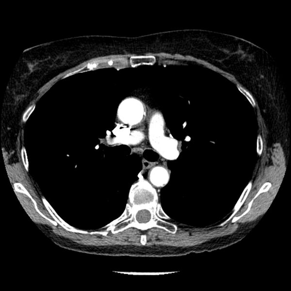 File:Adenocarcinoma of the lung (Radiopaedia 41015-43755 Axial C+ portal venous phase 49).jpg