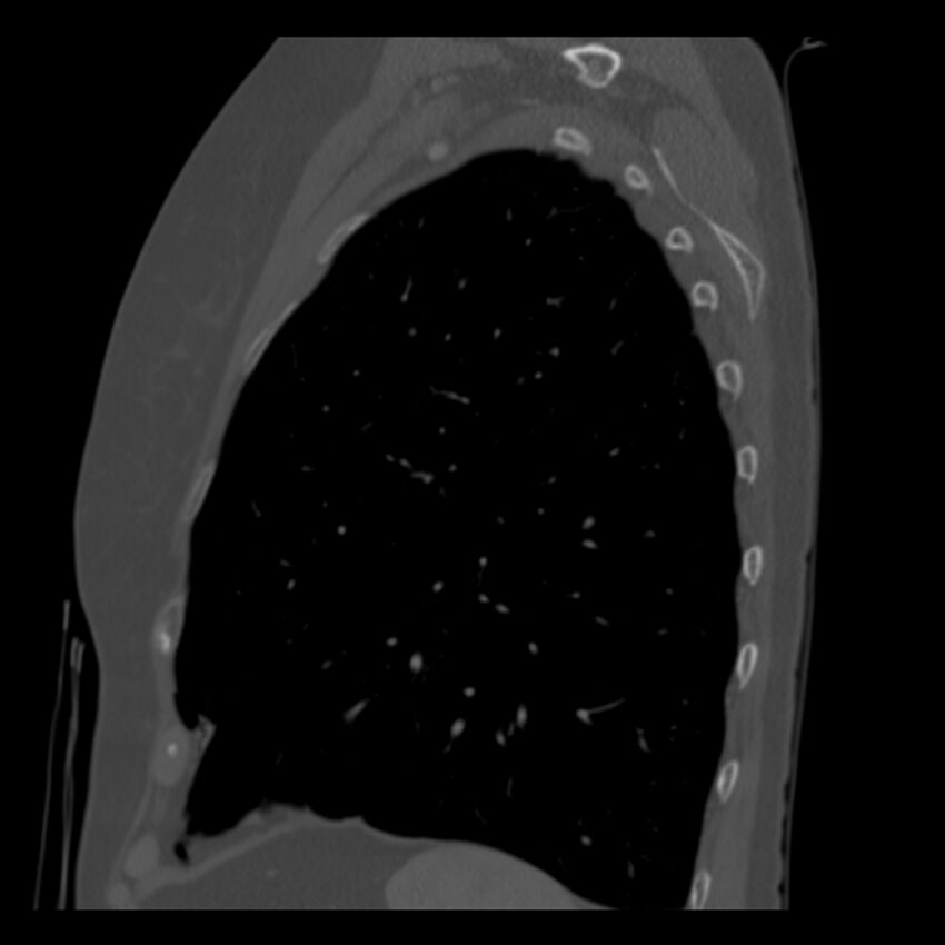 Adenocarcinoma of the lung (Radiopaedia 41015-43755 Sagittal bone window 86).jpg