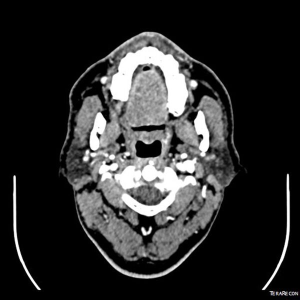 File:Adenoid cystic carcinoma involving paranasal sinus (Radiopaedia 16580-16283 Axial C+ arterial phase 10).jpeg
