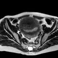 Adenomyoma of the uterus (huge) (Radiopaedia 9870-10438 Axial T2 27).jpg