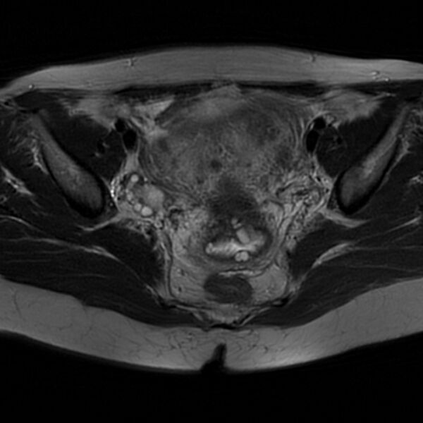 File:Adenomyosis within a septate uterus (Radiopaedia 69963-79981 Axial T2 19).jpg