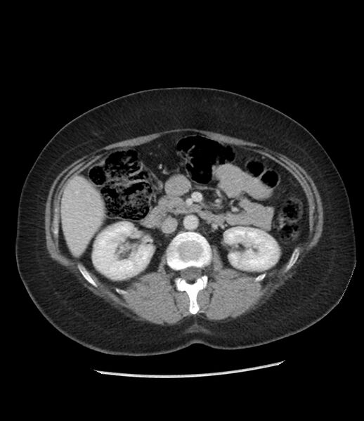 File:Adrenal cortical carcinoma with IVC invasion and thrombosis (Radiopaedia 34307-35597 Axial C+ portal venous phase 38).jpg