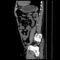 Adrenal myelolipoma (Radiopaedia 41843-44834 Sagittal non-contrast 29).jpg