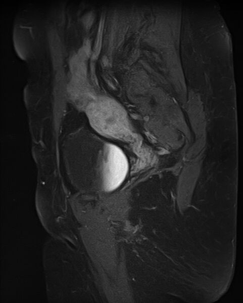 File:Adult granulosa cell tumor of the ovary (Radiopaedia 71581-81950 Sagittal T1 C+ fat sat 17).jpg