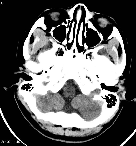 File:Aicardi syndrome (Radiopaedia 5353-7116 Axial non-contrast 3).jpg