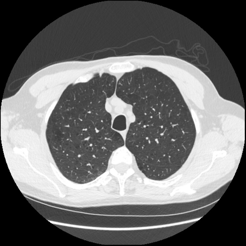Alpha-1-antitrypsin deficiency (Radiopaedia 40993-43722 Axial lung window 45).jpg