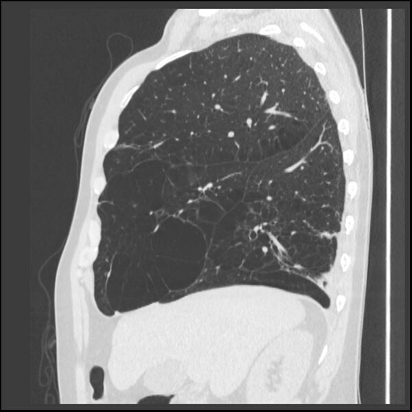 File:Alpha-1-antitrypsin deficiency (Radiopaedia 40993-43722 Sagittal lung window 196).jpg