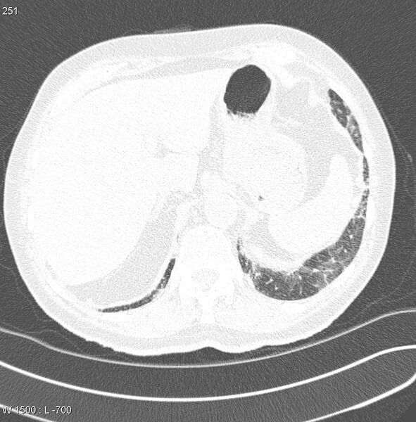File:Amiodarone lung (Radiopaedia 6539-7851 Axial lung window 24).jpg
