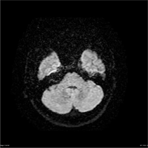File:Amnestic syndrome secondary to hypoxic brain injury (Radiopaedia 24743-25004 DWI 9).jpg