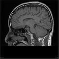 Amnestic syndrome secondary to hypoxic brain injury (Radiopaedia 24743-25004 T1 8).jpg