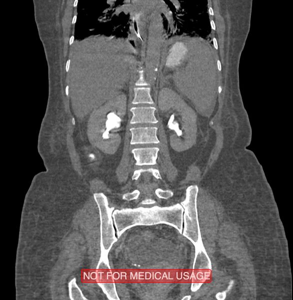 File:Amoebic enterocolitis with liver abscess (Radiopaedia 35100-36609 B 136).jpg