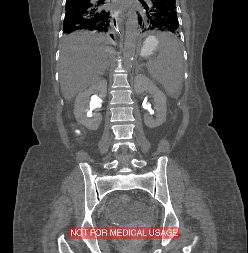 Amoebic enterocolitis with liver abscess (Radiopaedia 35100-36609 B 136).jpg