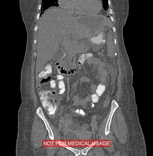 File:Amoebic enterocolitis with liver abscess (Radiopaedia 35100-36609 B 81).jpg