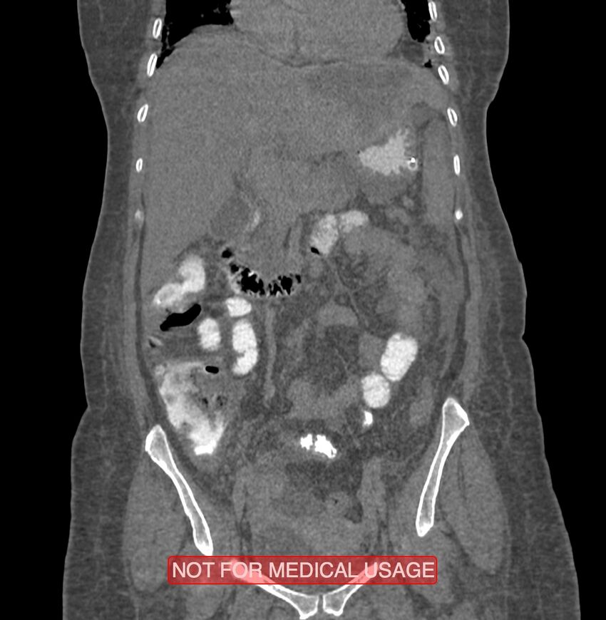 Amoebic enterocolitis with liver abscess (Radiopaedia 35100-36609 B 81).jpg