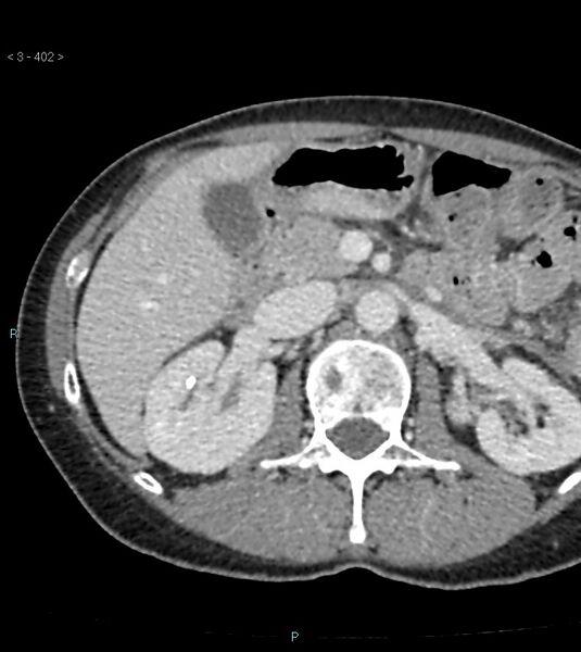 File:Ampulla of Vater metastasis (Radiopaedia 27820-28065 A 6).jpg