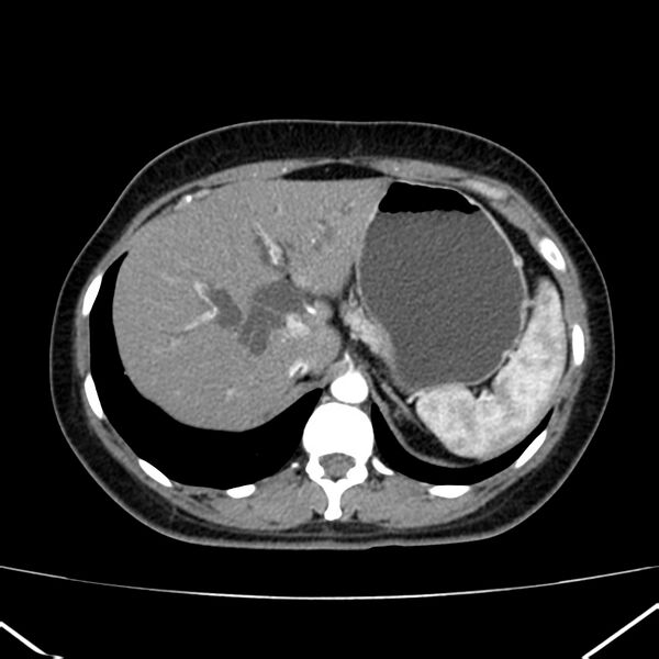 File:Ampullary tumor (Radiopaedia 22787-22816 B 21).jpg