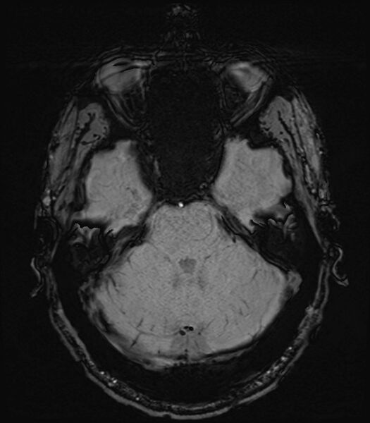 File:Amyotrophic lateral sclerosis (Radiopaedia 87352-103658 Axial SWI 12).jpg