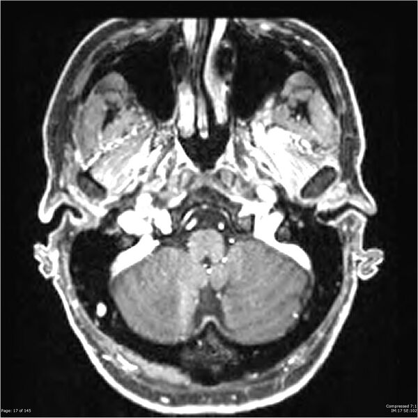 File:Anaplastic meningioma with recurrence (Radiopaedia 34452-35788 Axial T1 C+ 17).jpg