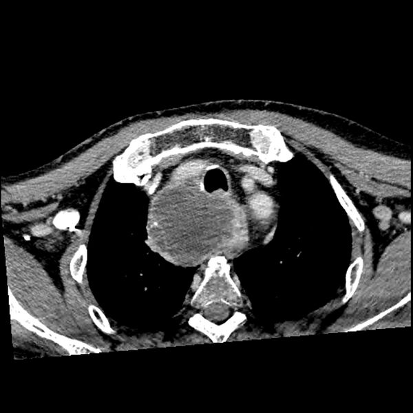 File:Anaplastic thyroid carcinoma (Radiopaedia 79087-92034 B 17).jpg