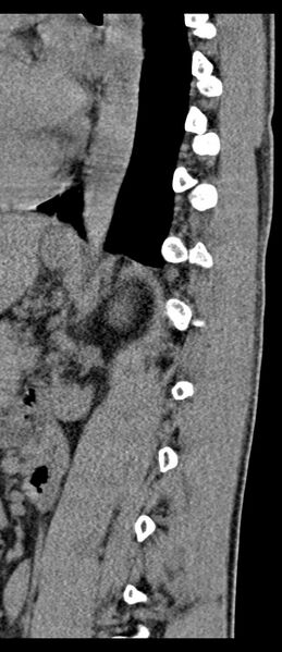 File:Aneurysmal bone cyst T11 (Radiopaedia 29294-29721 E 22).jpg