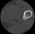 Aneurysmal bone cyst of ischium (Radiopaedia 25957-26094 B 58).png