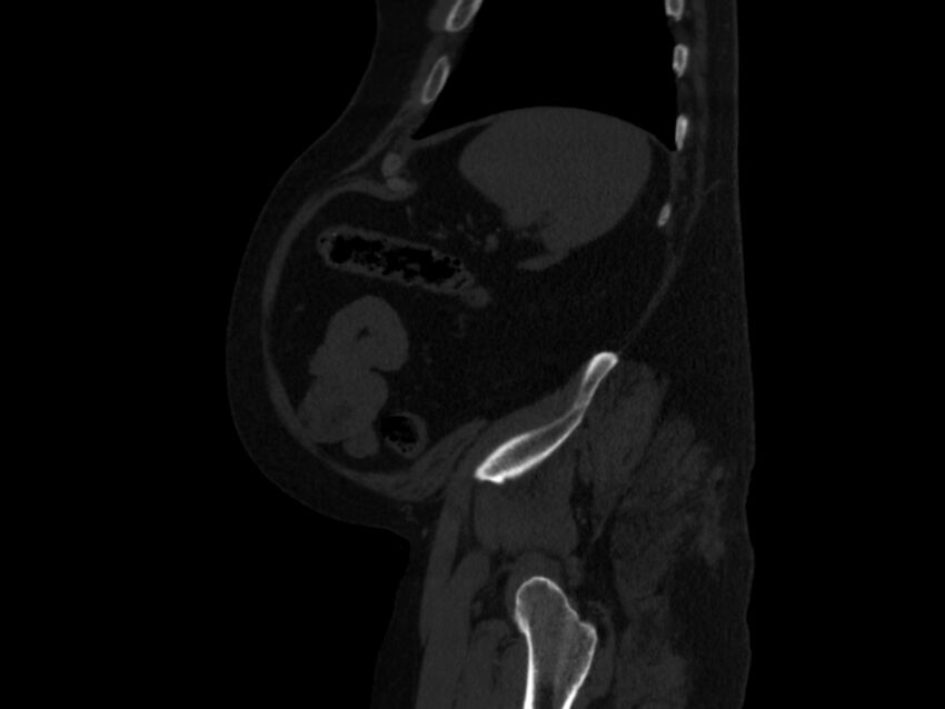 Ankylosing spondylitis (Radiopaedia 44609-48357 Sagittal bone window 96).jpg