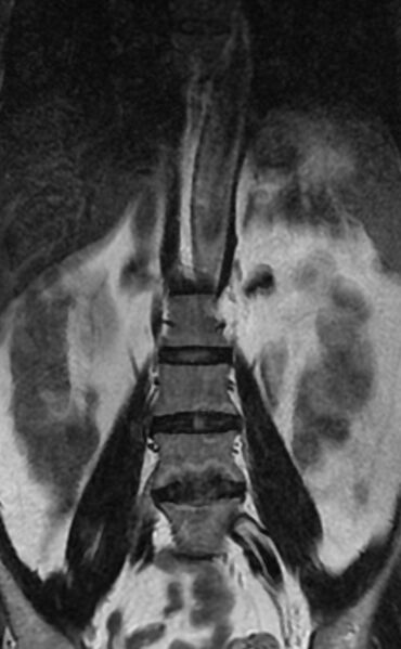 File:Ankylosing spondylitis - Andersson lesion (Radiopaedia 81878-95838 Coronal T2 4).jpg