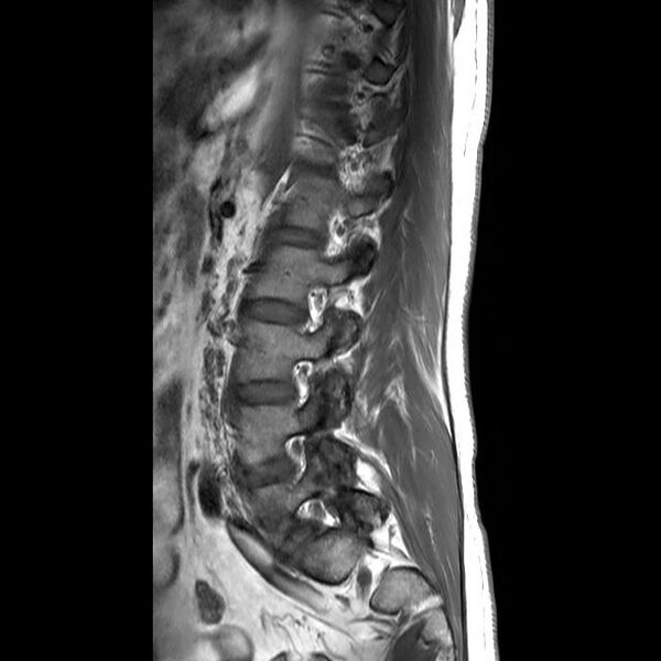 File:Ankylosing spondylitis with zygapophyseal arthritis (Radiopaedia 38433-40516 Sagittal T1 2).jpg