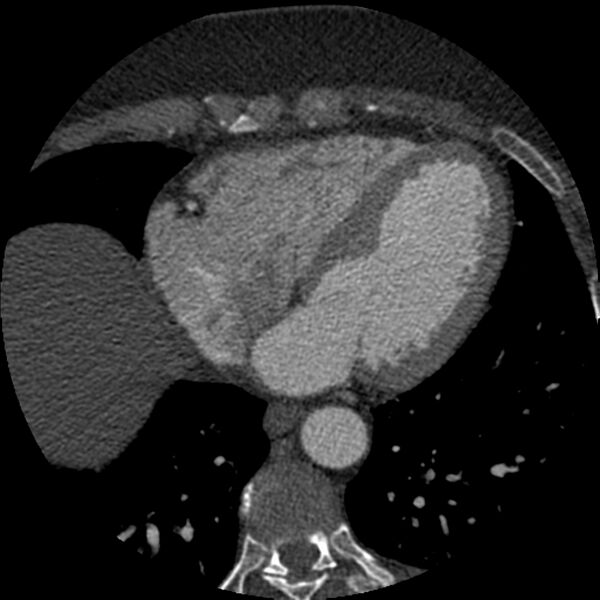 File:Anomalous origin of left circumflex artery from right coronary sinus (Radiopaedia 72563-83117 B 111).jpg