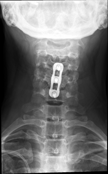 File:Anterior cervical discectomy and fusion (ACDF) (Radiopaedia 38120-40109 Frontal 1).png