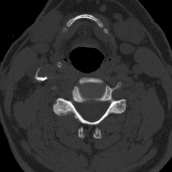 File:Anterior cervical postdiscectomy arthrodesis (Radiopaedia 32678-33646 Axial bone window 40).jpg